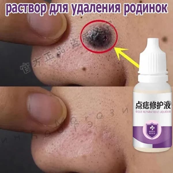 Жидкость для удаления родинок, используется для удаления папиллом, родинок, бородавок, жидкости для восстановления грубой кожи тела, 10 мл.