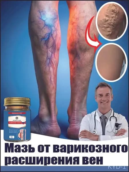 мазь для лечения варикозного расширения вен ног, подходит для лечения отеков и тяжести в ногах, сосудистой сеточки, тромбов, 50 г.