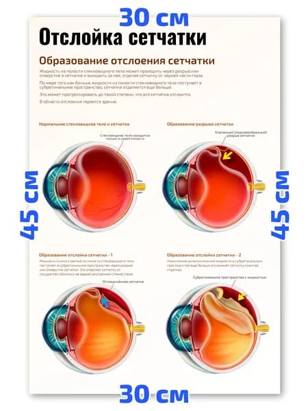 Плакат А3 Отслойка сетчатки медицинский плакат по офтальмологии 30х45 см