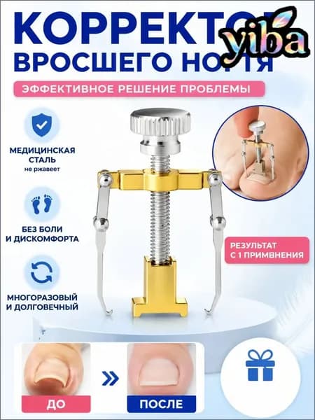 Коррекция вросших ногтей