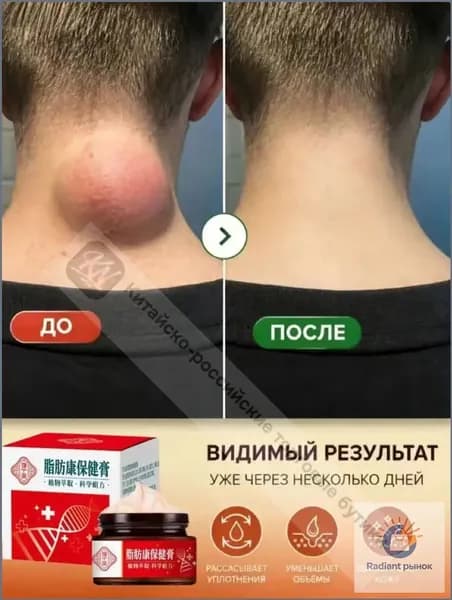 Крем для удаления подкожных припухлостей щитовидная железа липомы 30 г.быстро удаляет подкожные жировые опухоли, подходит для лечения отеков кожи, угрей, фурункулов, лимфаденита.