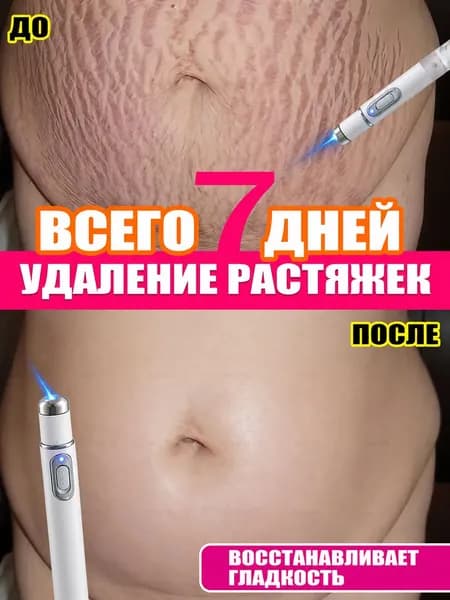 Бытовая лазерная указка от растяжек, нет необходимости обращаться в больницу, чтобы легко избавиться от растяжек,1pc