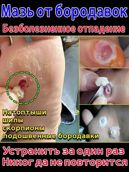 Мазь от шипиц, подошвенных и ладонно-подошвенных бородавок, натоптышей и мозолей на ногах - эффективное удаление и лечение для женщин и мужчин