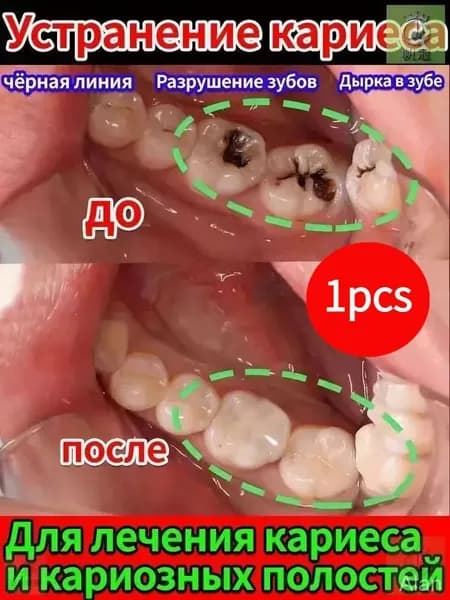 Зубная паста для дырки в зубе, глубокого кариеса и пульпита, Снимает боль, восстанавливает при поражении кариесом у взрослых, Свежее дыхание, 100 г, 1 шт.