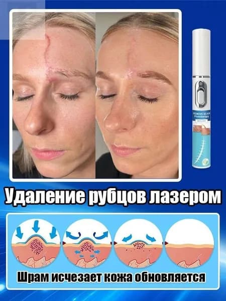 Лазерная ручка для удаления шрамов, используемая для удаления шрамов, растяжек, травм и пигментации, устранения рубцов, восстановления гладкости кожи и быстрого заживления. одна лазерная ручка