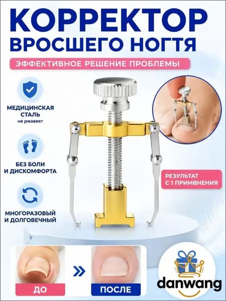 Коррекция вросших ногтей