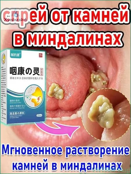 Новинка!Новинка! Набор для удаления миндалин