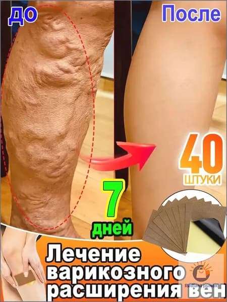 пластырь от варикоза на ногах,патчи от отеков,патчи для ногг,40 шт.
