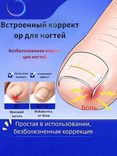 Набор для коррекции вросшего ногтя из никель-титанового для
