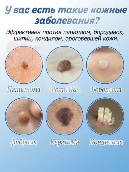средство от папиллом и бородавок Уменьшает проявления за 7 дней.Крем средство для удаления бородавок, папиллом и родинок
