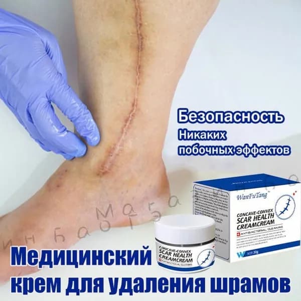 Медицинский крем от шрамов 30г, быстрая починка рубцов, от постакне, растяжек для беременных и пигментации, Безопасно, без побочных эффектов, для лица и тела