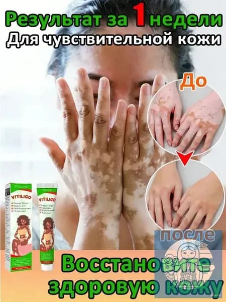 Мазь от витилиго,Средство при нежелательной пигментации витилиго.20 мл
