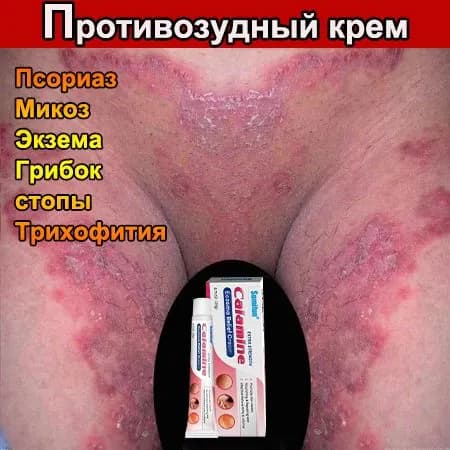 Мазь от псориаза / Крем для ухода за кожей при псориазе, 20 г,экземе и герпесе, акне, ожогах, порезах, от прыщей на лице, укусов насекомых.