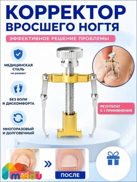 Коррекция вросших ногтей