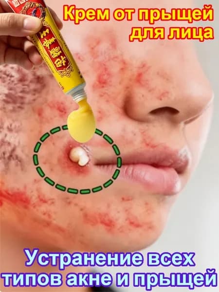 Паста с цинком и салициловой кислотой, крем от прыщей на лице для подростков и взрослых
