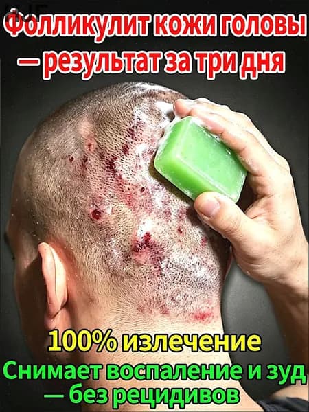 Лечебное мыло от фолликулита кожи головы противогрибковое натуральное снимает зуд и воспаление быстрый результат