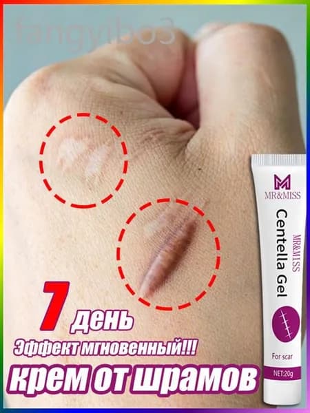 Средство от растяжек