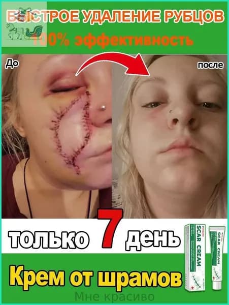 Крем для удаления шрамов. Быстро удаляет шрамы, растяжки, следы от акне и ожогов. Мягкий и не раздражающий, подходит как мужчинам, так и женщинам. 20 мл