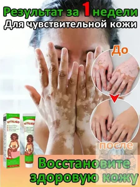 Мазь от витилиго,Средство при нежелательной пигментации витилиго.100 мл