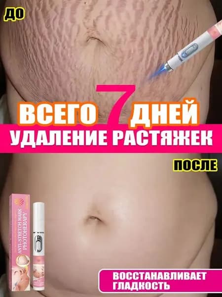 Бытовая лазерная указка от растяжек, нет необходимости обращаться в больницу, чтобы легко избавиться от растяжек,1pc