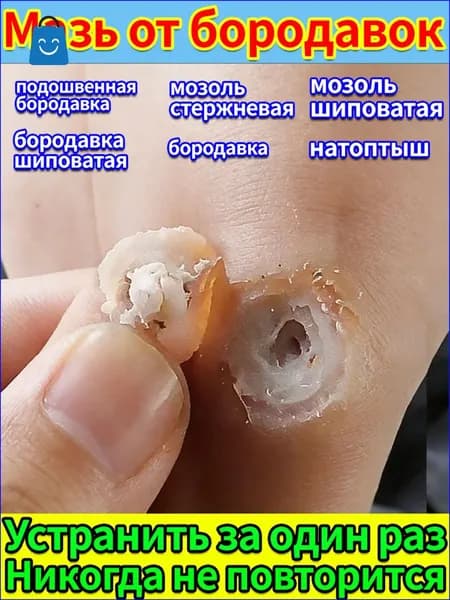 Паста для удаления шипиц и бородавок - лечение натоптышей на подошве