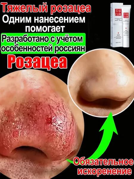 Крем от купероза для лица покраснений на лице и розацеа,Куперофаг Крем от купероза на лице, антикупероз, средство от сосудистых звездочек, от покраснений, розацеа,Китайская чудо-мазь.20 г