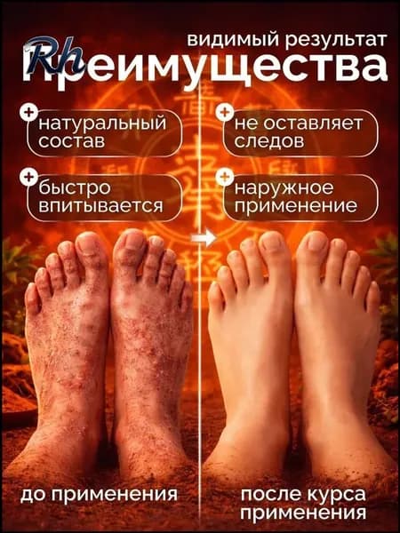 Мазь от псориаза, герпеса, экземы, дерматита, лишая, прыщей, акне , Китайская чудо мазь от псориаза и дерматита. Подарок на 8 марта женщине