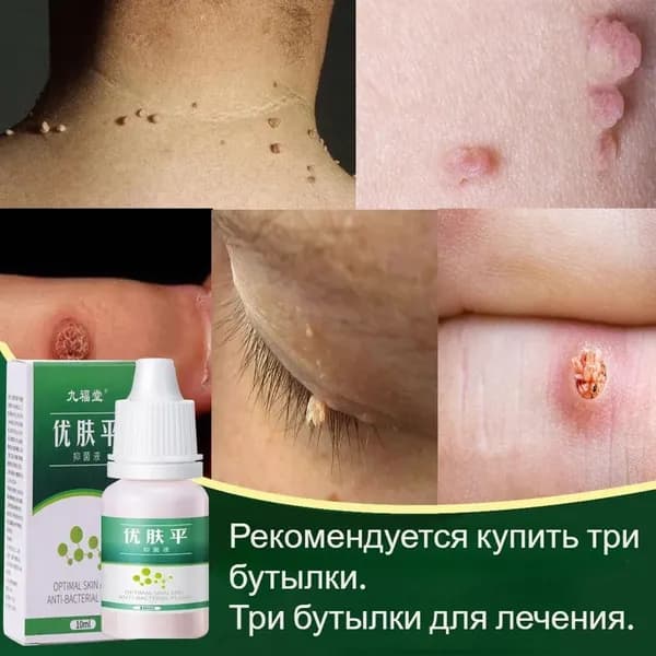 Используйте безопасный и не имеющий побочных эффектов раствор для снятия бородавок, чтобы быстро удалить куриный глаз