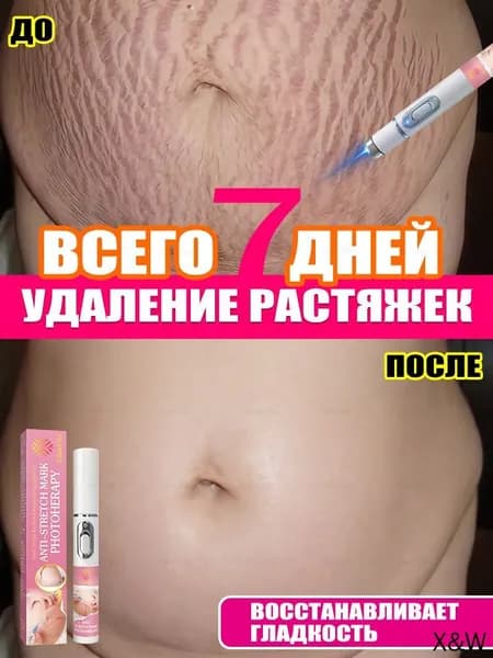 Бытовая лазерная указка от растяжек, нет необходимости обращаться в больницу, чтобы легко избавиться от растяжек, 2pc