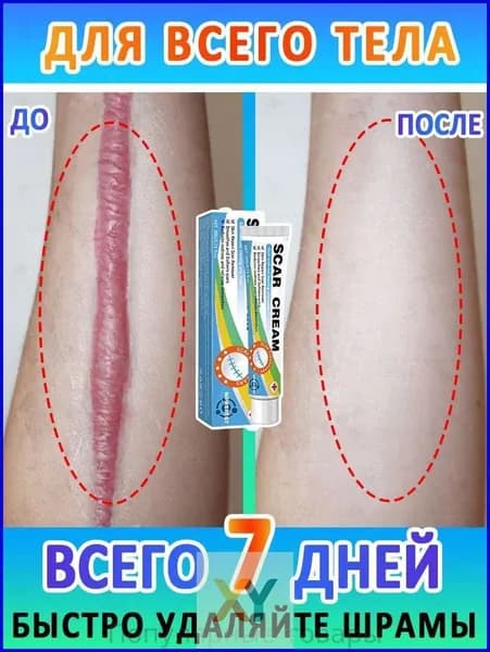Этот крем для заживления рубцов снимает зуд и быстро удаляет гипертрофические рубцы, ожоги, угри, старые шрамы, растяжки, а также оказывает мягкое и нераздражающее действие.