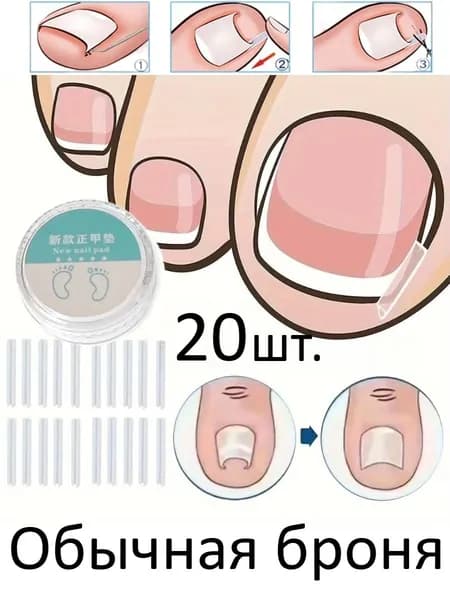 Ортогнатическая Подушечка, Коррекция Вросшего Ногтя