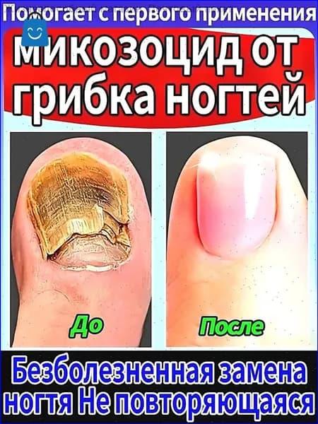Противогрибковая мазь Ноготок от грибка ногтей на ногах и гиперкератоза, противогрибковое средство для ног,укрепляйте и восстанавливайте ногти, крем для лечения 20g