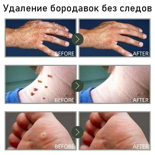Крем от бородавок и папиллом для удаления родинок и кожных наростов без боли с чистотелом