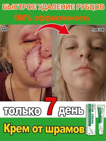 Крем для удаления шрамов. Быстро удаляет шрамы, растяжки, следы от акне и ожогов. Мягкий и не раздражающий, подходит как мужчинам, так и женщинам. 20 мл
