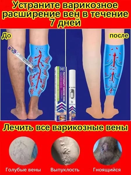 Лазерное лечение варикозного расширения вен. эффективное и быстрое удаление, безболезненное, без шрамов, без побочных эффектов