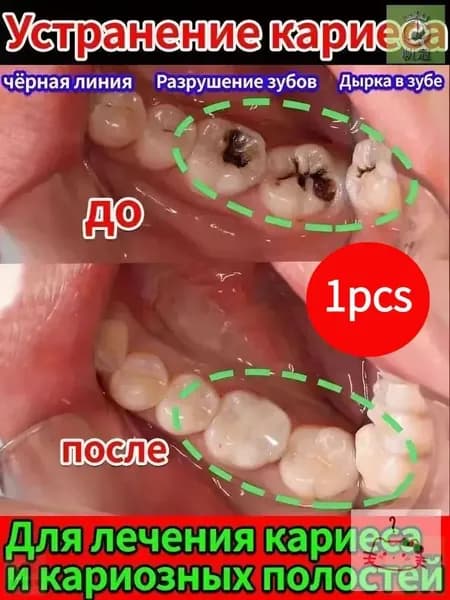 Восстановление десен и укрепление зубов при рецессии - гель с регенерирующим кремнием