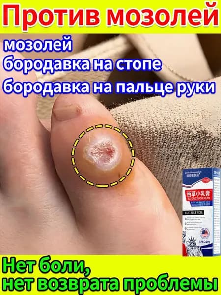 Пластырь и мазь для удаления стержневых мозолей и натоптышей на стопах и пальцах ног. Лечение сухих и болезне