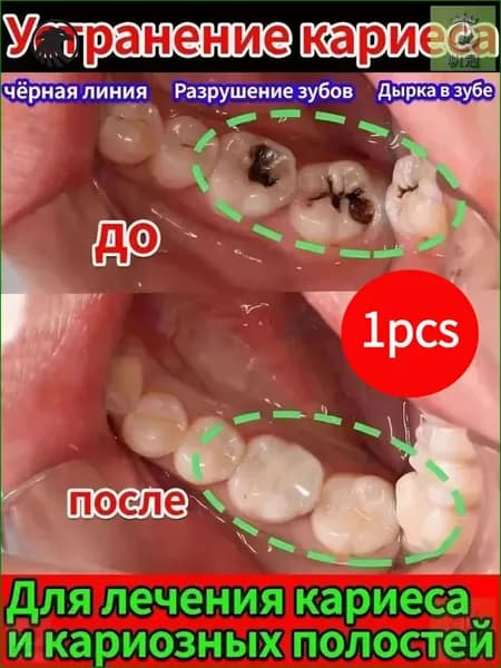Восстановление десен и укрепление зубов при рецессии - гель с регенерирующим кремнием
