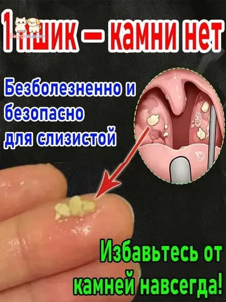 Прибор и спрей для очистки миндалин от пробок