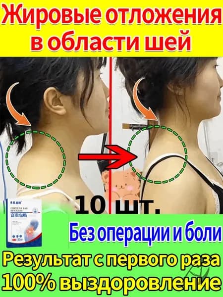 Пластыри от вдовьего горбика - 10 шт: убирают жировой горб на шее