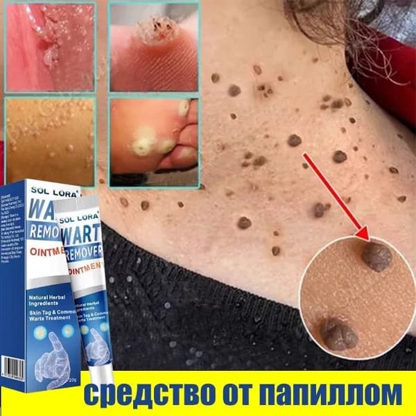 Эксклюзивный крем 20g для проблемной кожи, удаляющий родинки, папилломы и бородавки на лице