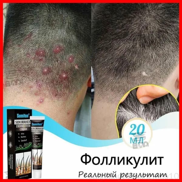 Средство для лечения кожи головы и волос