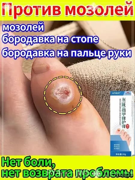 Пластырь и мазь для удаления стержневых мозолей и натоптышей на стопах и пальцах ног. Лечение сухих и болезне