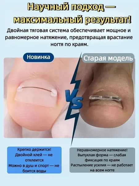 Набор для коррекции вросшего ногтя из никель-титанового сплав