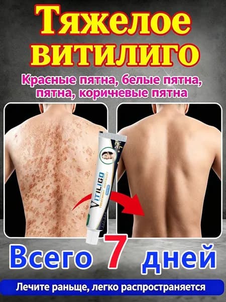 Мазь для лечения витилиго, эффективно удаляет белые пятна и регулирует пигментацию, выравнивает тон кожи и устраняет странные взгляды окружающих, 20 грамм