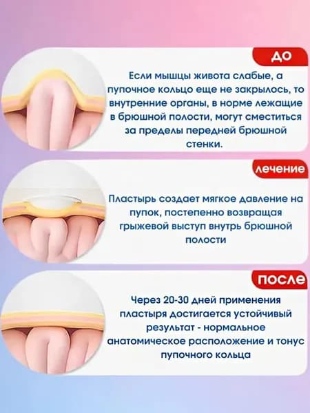 Пластырь от пупочной грыжи детский для новорожденных