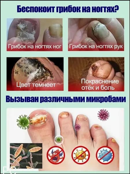 2 штуки,крем ноготок от грибка ногтей на ногах,ноготок мазь от грибка на ногах,гиперкератоз
