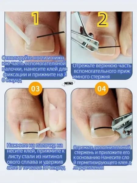 Набор из 10+5 предметов из никель-титанового сплава для коррекции вросшего ногтя на пальце ноги
