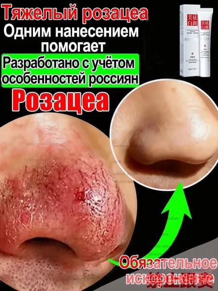 Крем от купероза для лица покраснений на лице и розацеа,Куперофаг Крем от купероза на лице, антикупероз, сред