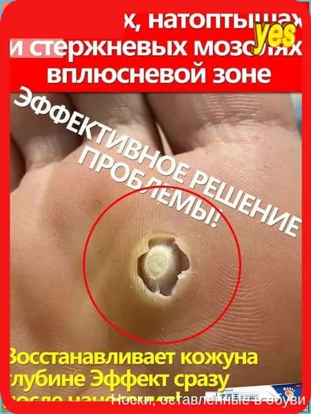 Скидка сегодняпри болях, шишках и в плюсневой зоне, от стержневых шишек 20 г